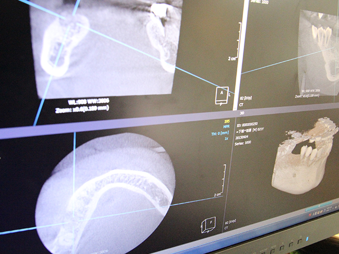 歯科用CTと拡大鏡による精密な診断・治療